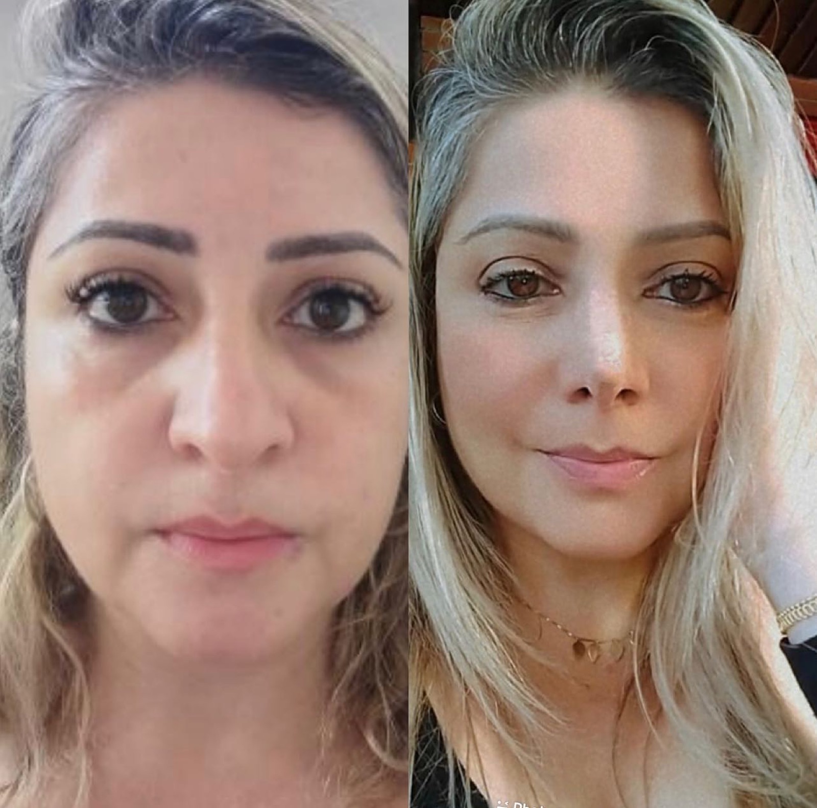 Resultado real de paciente Prime HOF — antes e depois