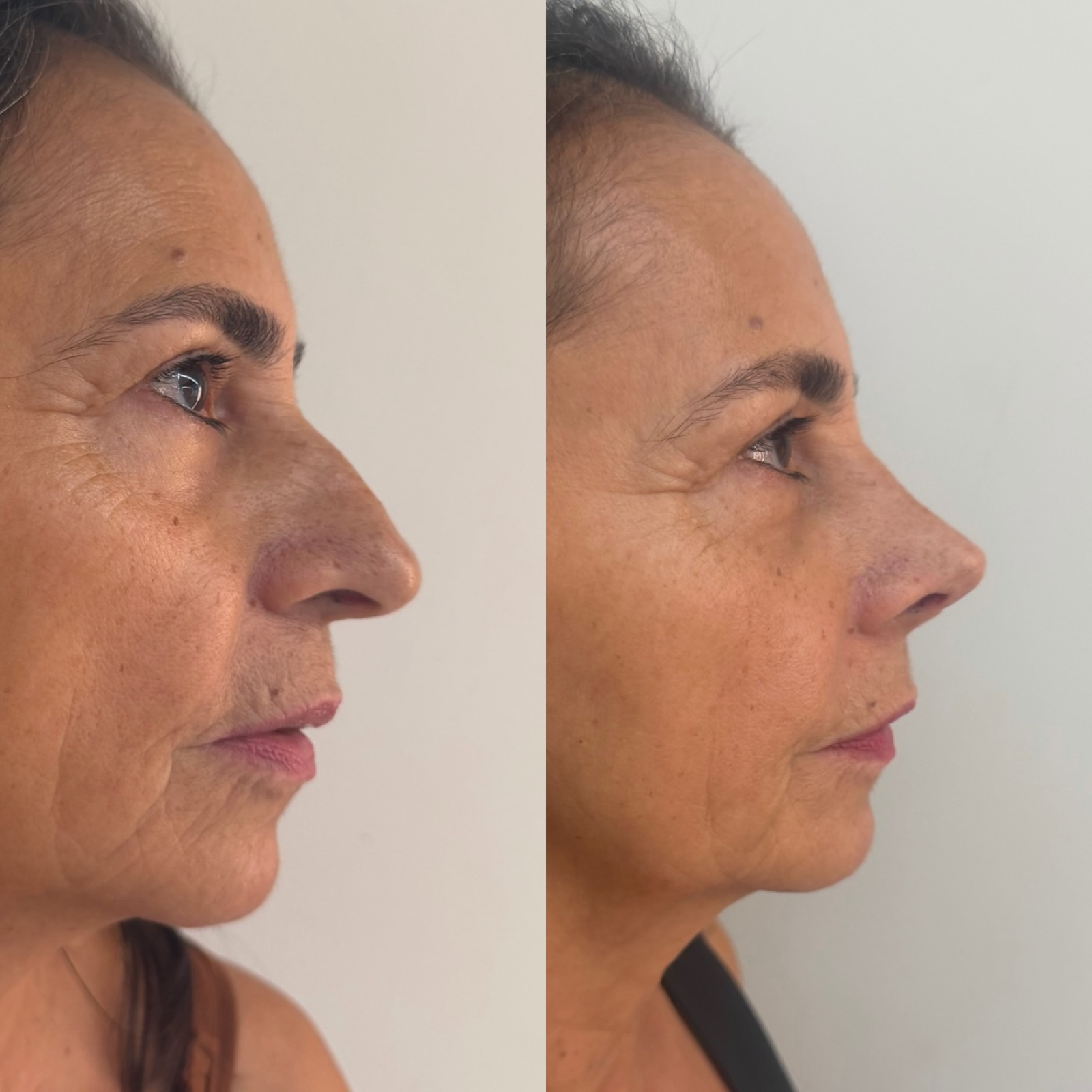 Resultado real de paciente Prime HOF — antes e depois