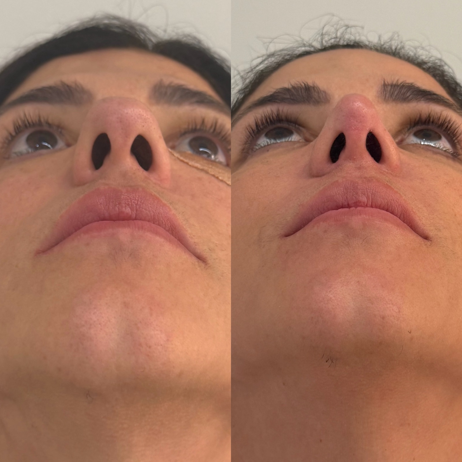 Resultado real de paciente Prime HOF — antes e depois